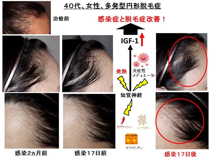 円形脱毛症　病院